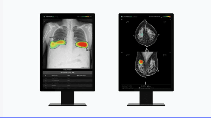 Use of AI Screening Tool for Cancer Expands Globally